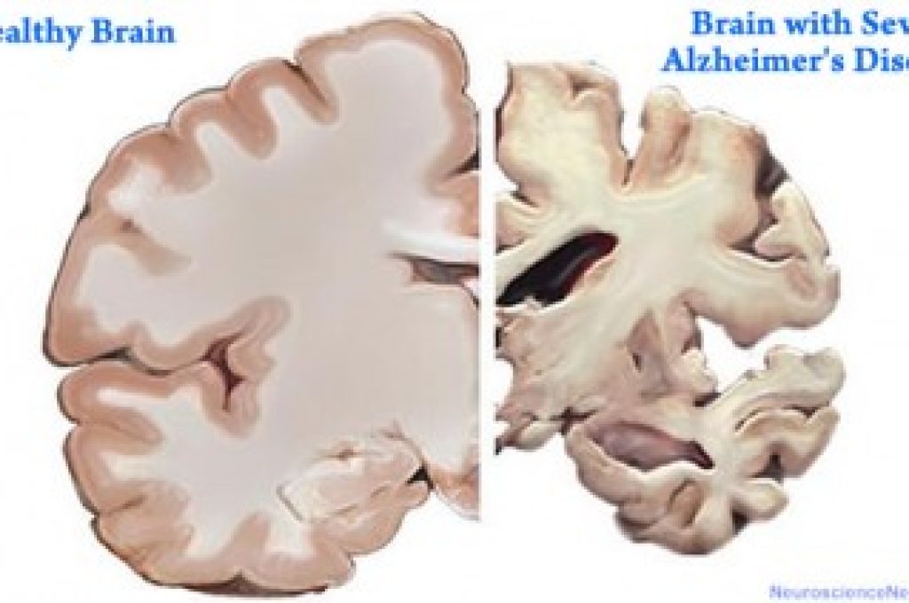 Sindrome Di Down Parkinson E Alzheimer Nuove Speranze Da Bari